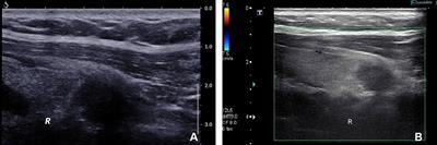 Case Reports: A role of postoperative radiation therapy in completely resected early stage intrathyroid thymic carcinoma: a case report and literature review of the diagnosis and treatment